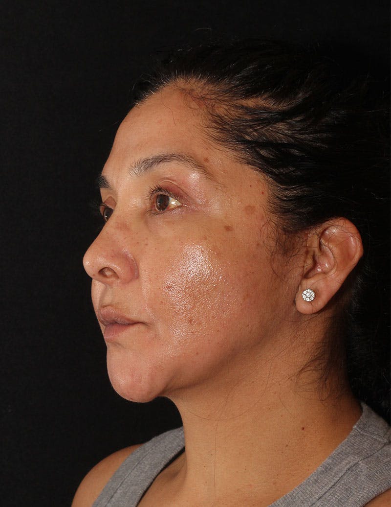 Facelift/Necklift Before & After Gallery - Patient 119214 - Image 10