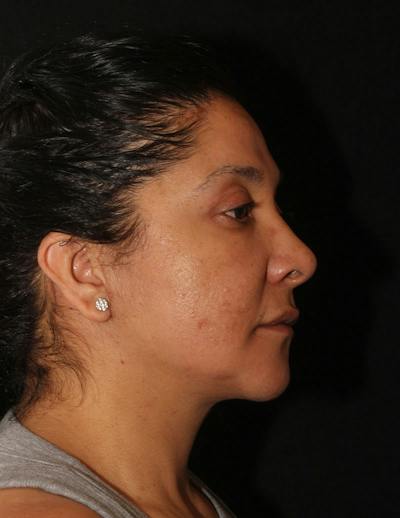 Facelift/Necklift Before & After Gallery - Patient 119214 - Image 2