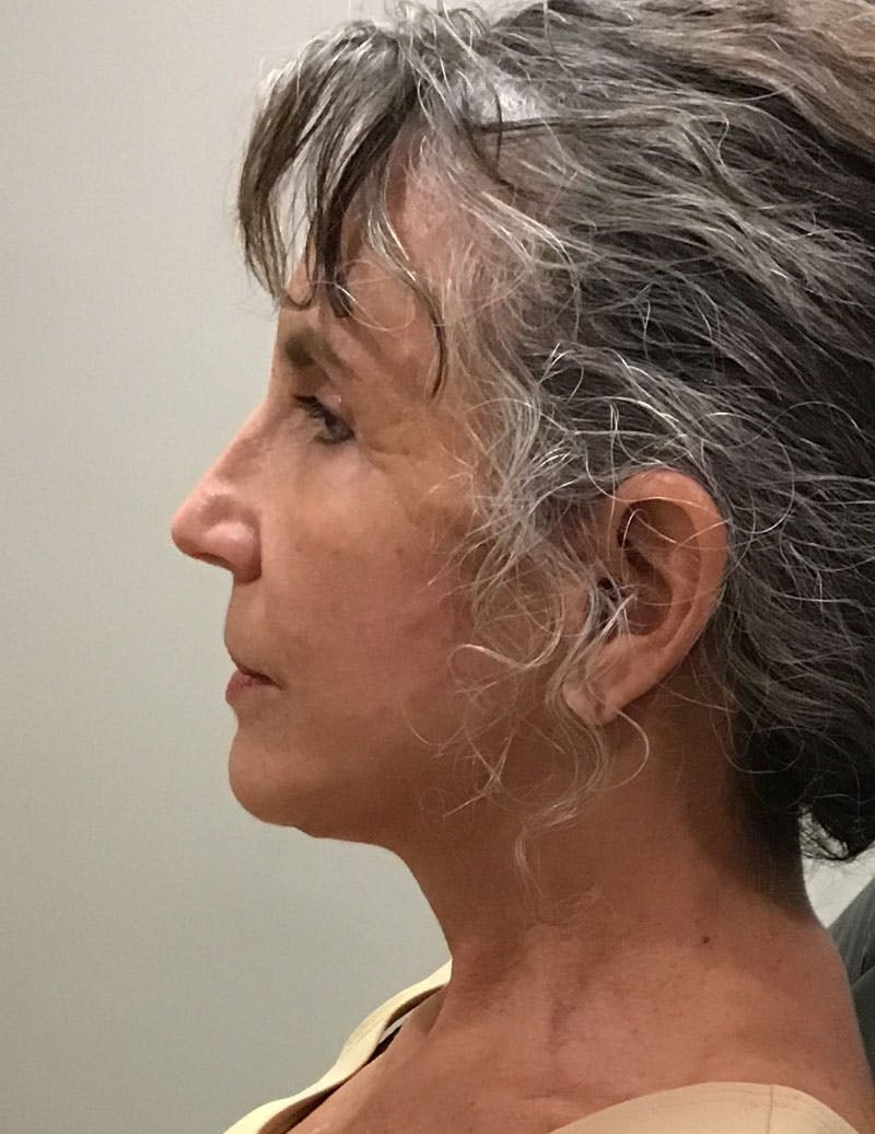 Facelift/Necklift Before & After Gallery - Patient 325266 - Image 5