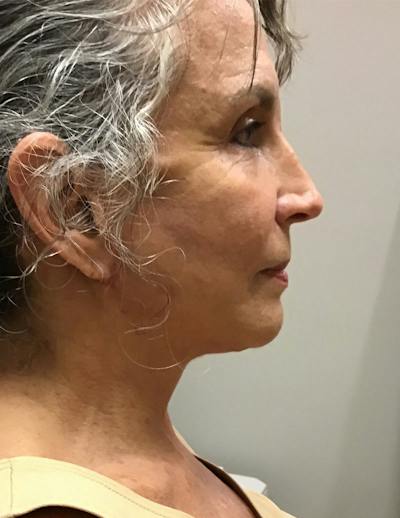 Facelift/Necklift Before & After Gallery - Patient 325266 - Image 2