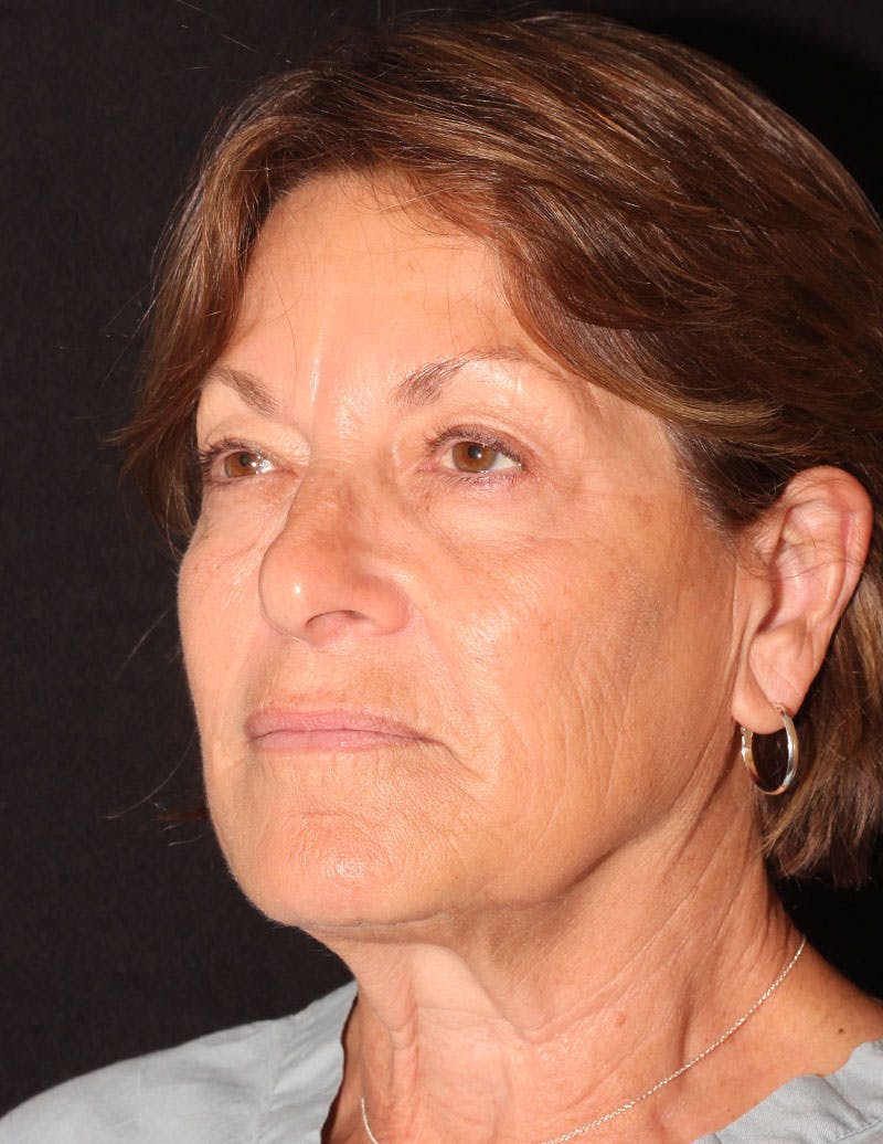 Facelift/Necklift Before & After Gallery - Patient 374887 - Image 10