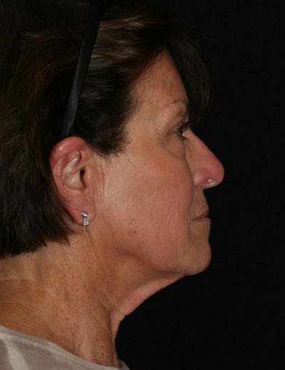 Facelift/Necklift Before & After Gallery - Patient 374887 - Image 1