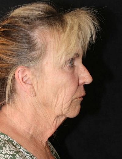 Facelift/Necklift Before & After Gallery - Patient 306448 - Image 1