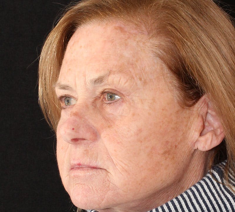 Blepharoplasty Before & After Gallery - Patient 354262 - Image 10