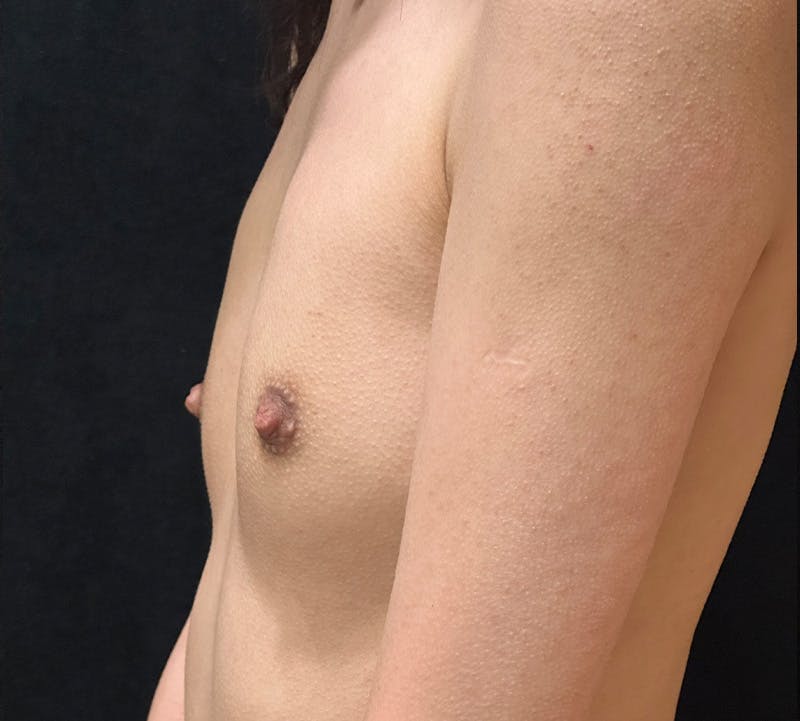 Breast Augmentation Before & After Gallery - Patient 352754 - Image 9