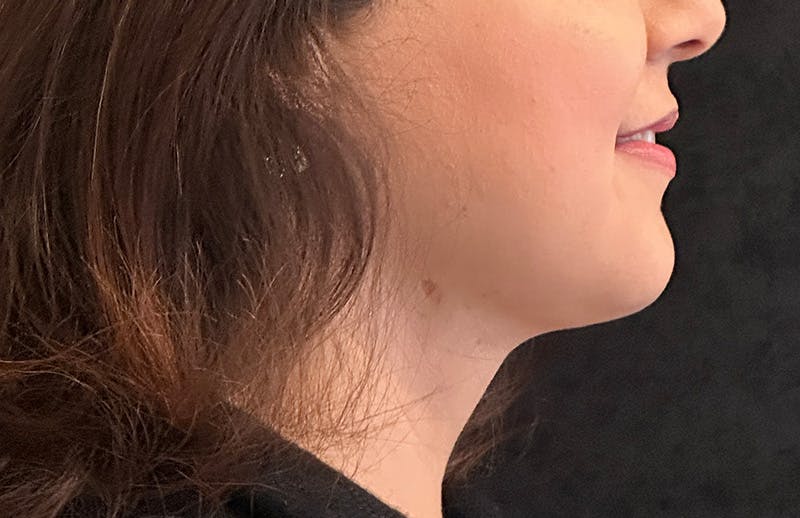 MyEllevate Before & After Gallery - Patient 130431 - Image 6