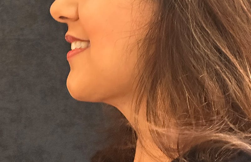 MyEllevate Before & After Gallery - Patient 130431 - Image 10