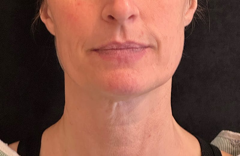 MyEllevate Before & After Gallery - Patient 562432 - Image 1