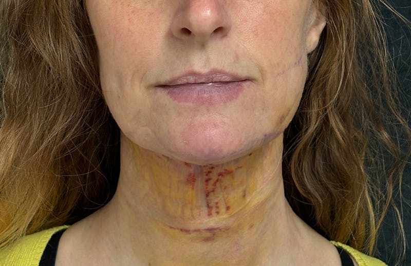 MyEllevate Before & After Gallery - Patient 562432 - Image 2