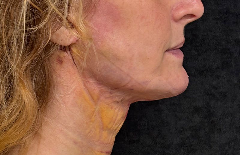 MyEllevate Before & After Gallery - Patient 562432 - Image 6