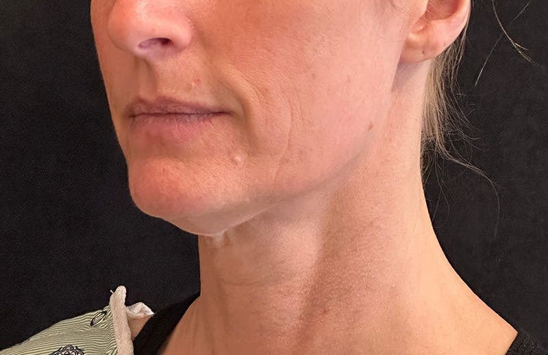 MyEllevate Before & After Gallery - Patient 562432 - Image 7