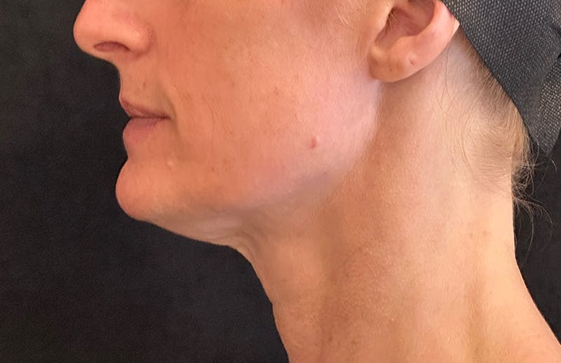 MyEllevate Before & After Gallery - Patient 562432 - Image 9