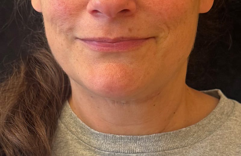 MyEllevate Before & After Gallery - Patient 173853 - Image 2