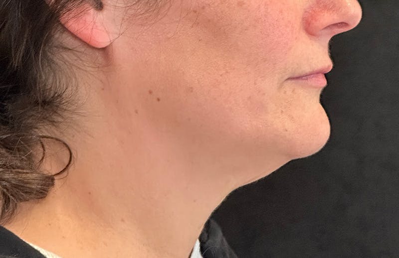 MyEllevate Before & After Gallery - Patient 173853 - Image 5