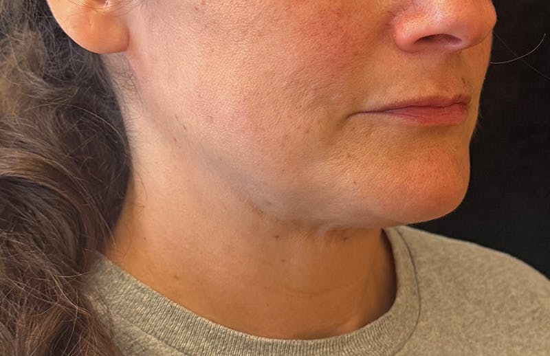 MyEllevate Before & After Gallery - Patient 173853 - Image 4