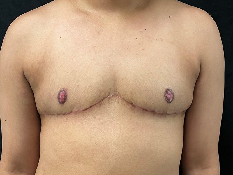 Top Surgery Before & After Gallery - Patient 249108 - Image 2
