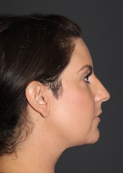 Facetite Before & After Gallery - Patient 104605 - Image 2