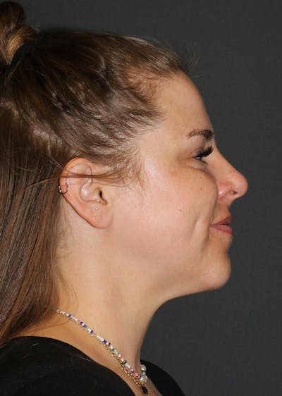 Facetite Before & After Gallery - Patient 477201 - Image 2