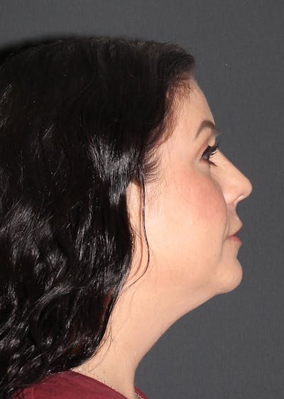 Facetite Before & After Gallery - Patient 187852 - Image 1