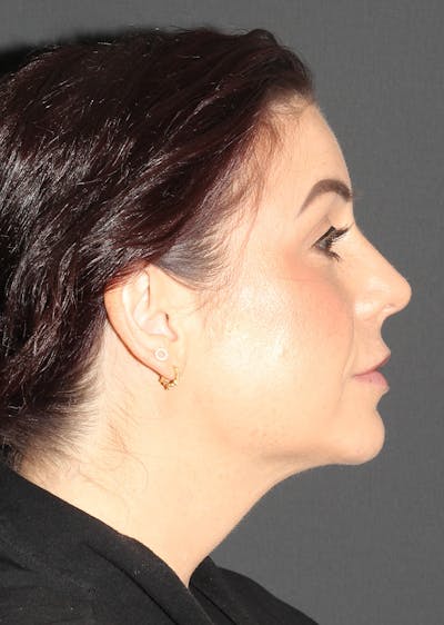 Facetite Before & After Gallery - Patient 187852 - Image 2