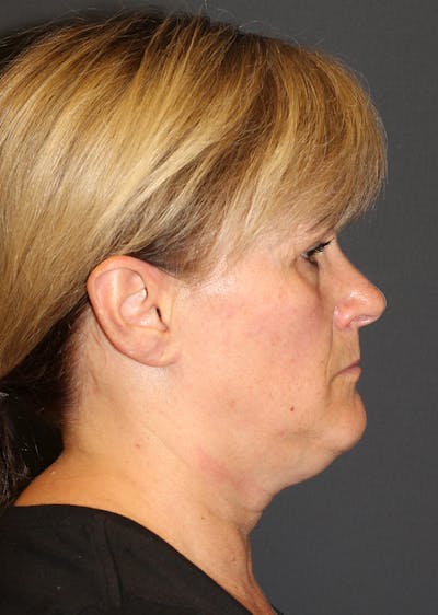 Facetite Before & After Gallery - Patient 203828 - Image 1