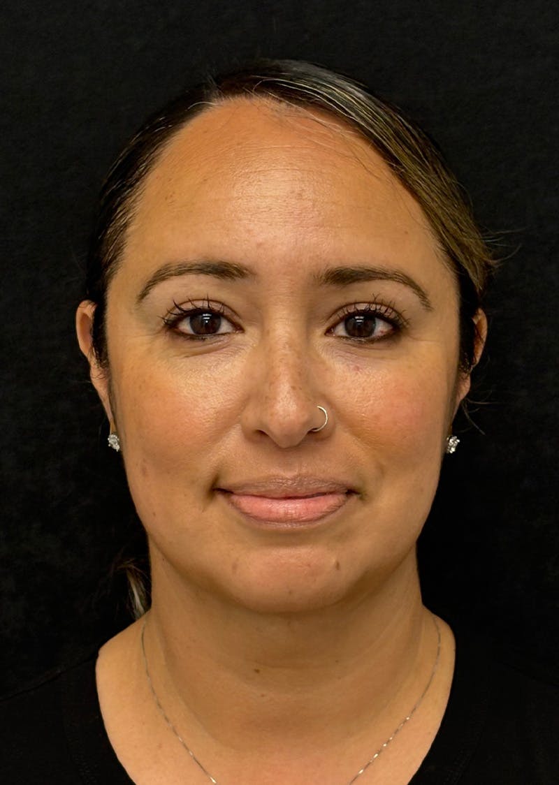 Facetite Before & After Gallery - Patient 603030 - Image 6