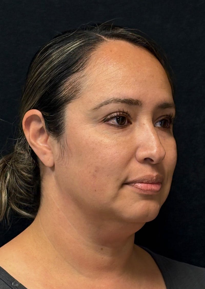 Facetite Before & After Gallery - Patient 603030 - Image 3