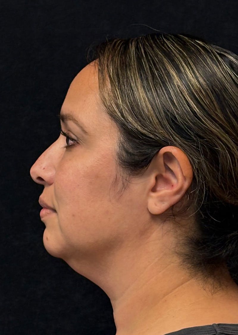 Facetite Before & After Gallery - Patient 603030 - Image 9