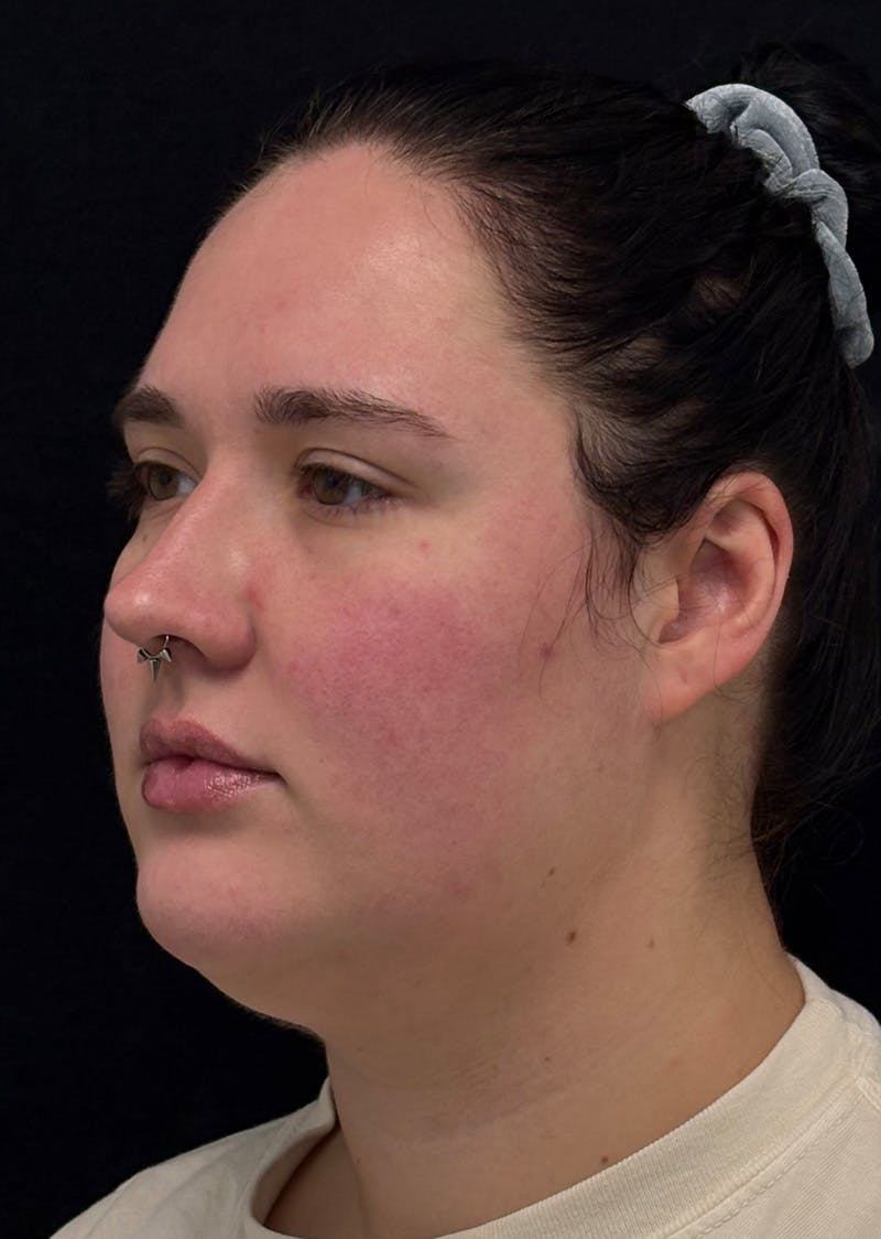 Facetite Before & After Gallery - Patient 282532 - Image 7