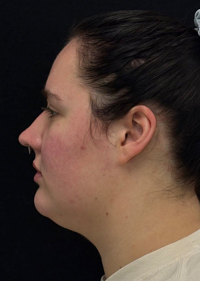 Facetite Before & After Gallery - Patient 282532 - Image 9