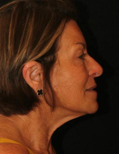 Facelift/Necklift Before & After Gallery - Patient 374887 - Image 2
