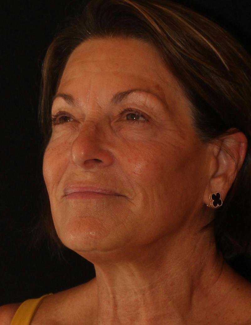 Facelift/Necklift Before & After Gallery - Patient 374887 - Image 8