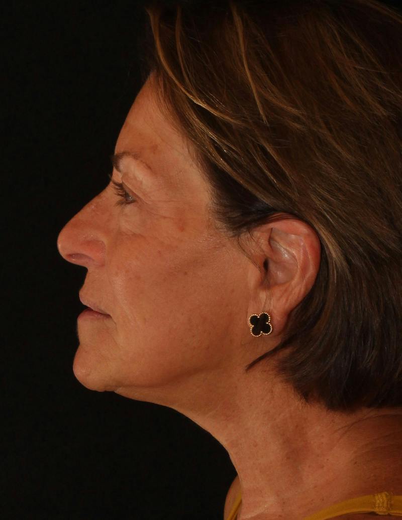 Facelift/Necklift Before & After Gallery - Patient 374887 - Image 10
