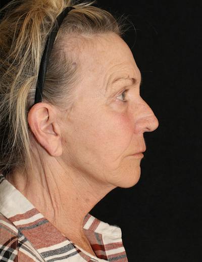 Facelift/Necklift Before & After Gallery - Patient 306448 - Image 2