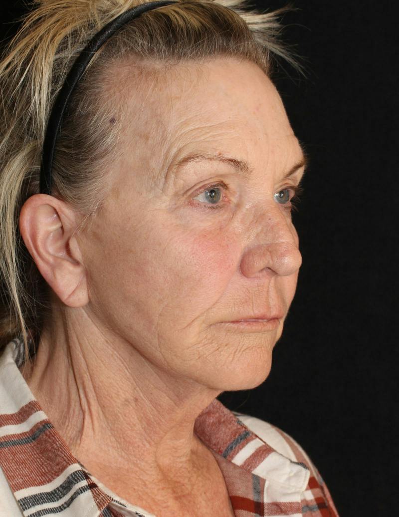 Facelift/Necklift Before & After Gallery - Patient 306448 - Image 4