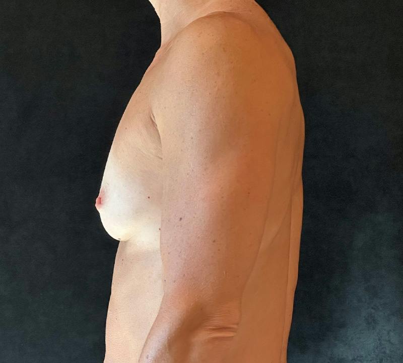 Preservé Breast Augmentation Before & After Gallery - Patient 133314 - Image 9