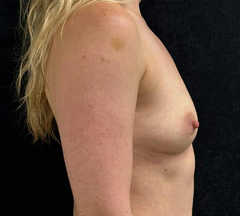 Preservé Breast Augmentation Before & After Gallery - Patient 227721 - Image 5