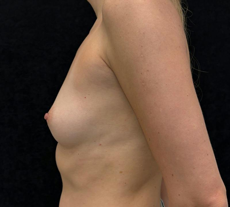 Preservé Breast Augmentation Before & After Gallery - Patient 350353 - Image 9