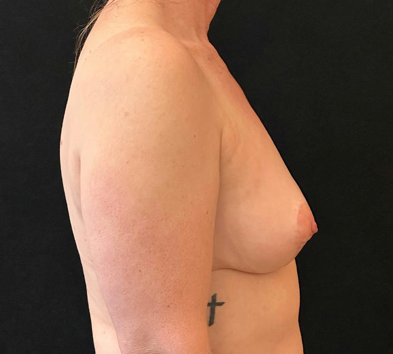 Fat Grafting Before & After Gallery - Patient 137459 - Image 6