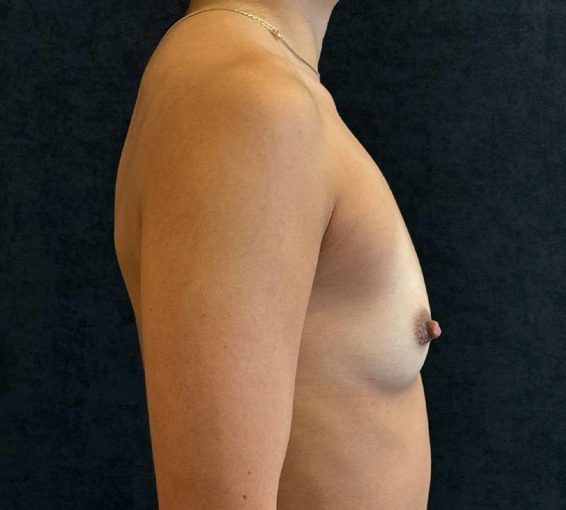 Breast Augmentation Subfascial Before & After Gallery - Patient 420715 - Image 5