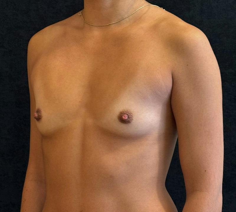 Breast Augmentation Subfascial Before & After Gallery - Patient 420715 - Image 7