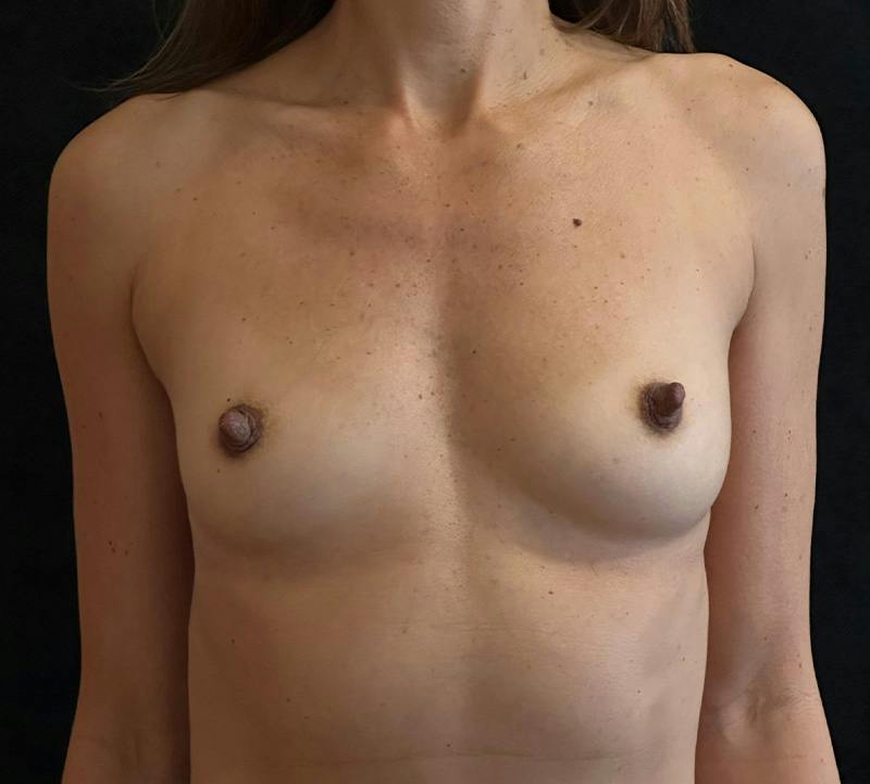Breast Augmentation Subfascial Before & After Gallery - Patient 256890 - Image 1