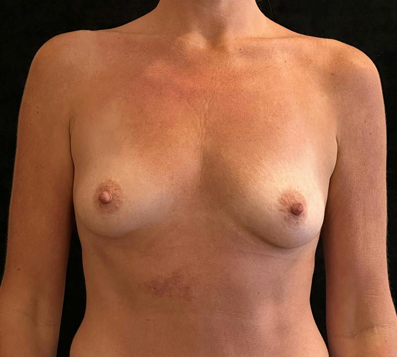 Breast Augmentation Subfascial Before & After Gallery - Patient 314329 - Image 1