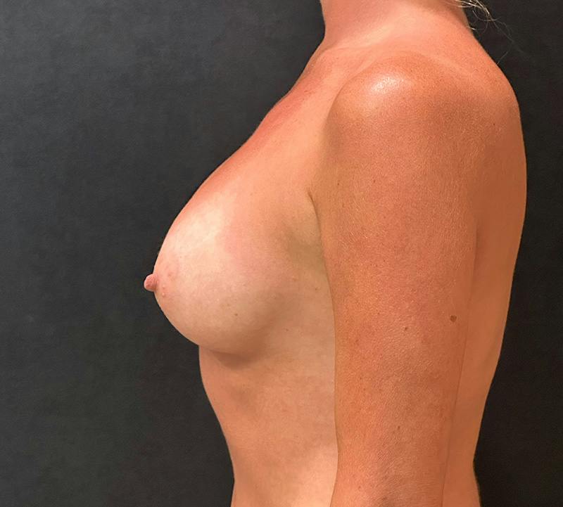 Breast Augmentation Subfascial Before & After Gallery - Patient 314329 - Image 10