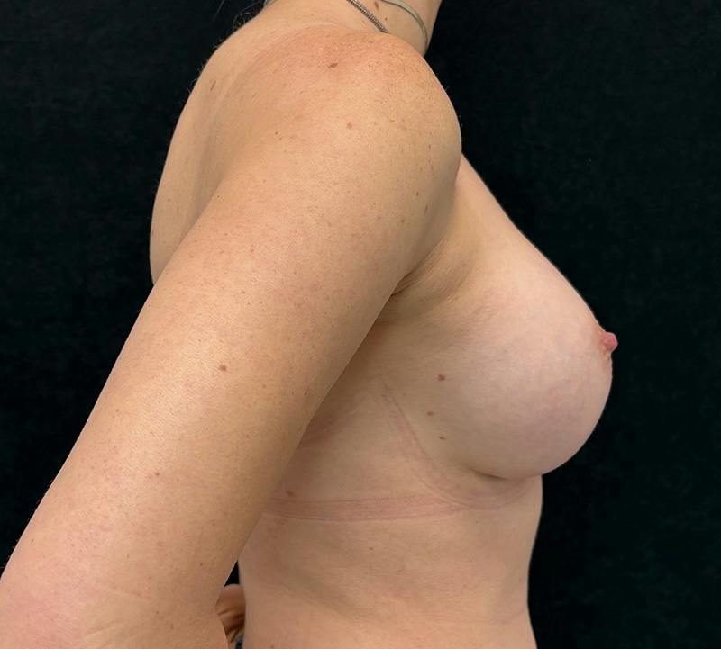 Breast Augmentation Subfascial Before & After Gallery - Patient 724054 - Image 6