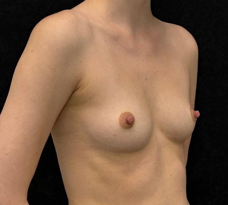 Breast Augmentation Subfascial Before & After Gallery - Patient 162233 - Image 3