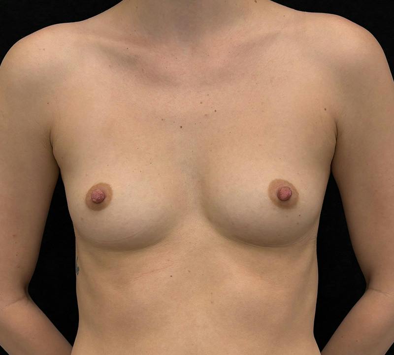 Breast Augmentation Subfascial Before & After Gallery - Patient 162233 - Image 1