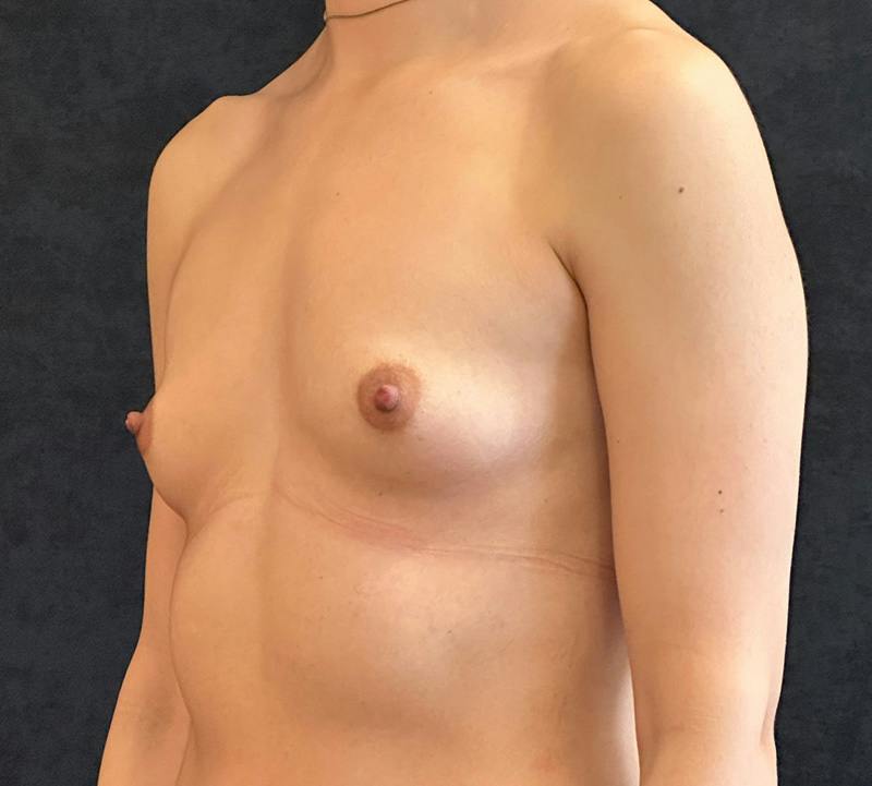 Breast Augmentation Subfascial Before & After Gallery - Patient 300094 - Image 7