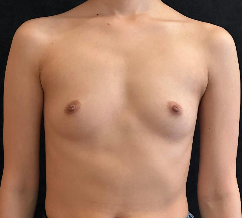 Breast Augmentation Subfascial Before & After Gallery - Patient 369001 - Image 1