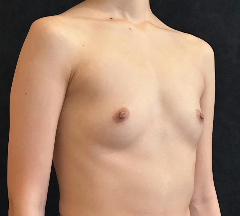 Breast Augmentation Subfascial Before & After Gallery - Patient 369001 - Image 3